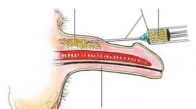 Member growth surgical method