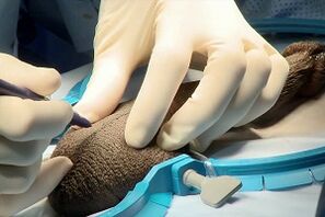 Midge cut for enlargement of the surgical penis